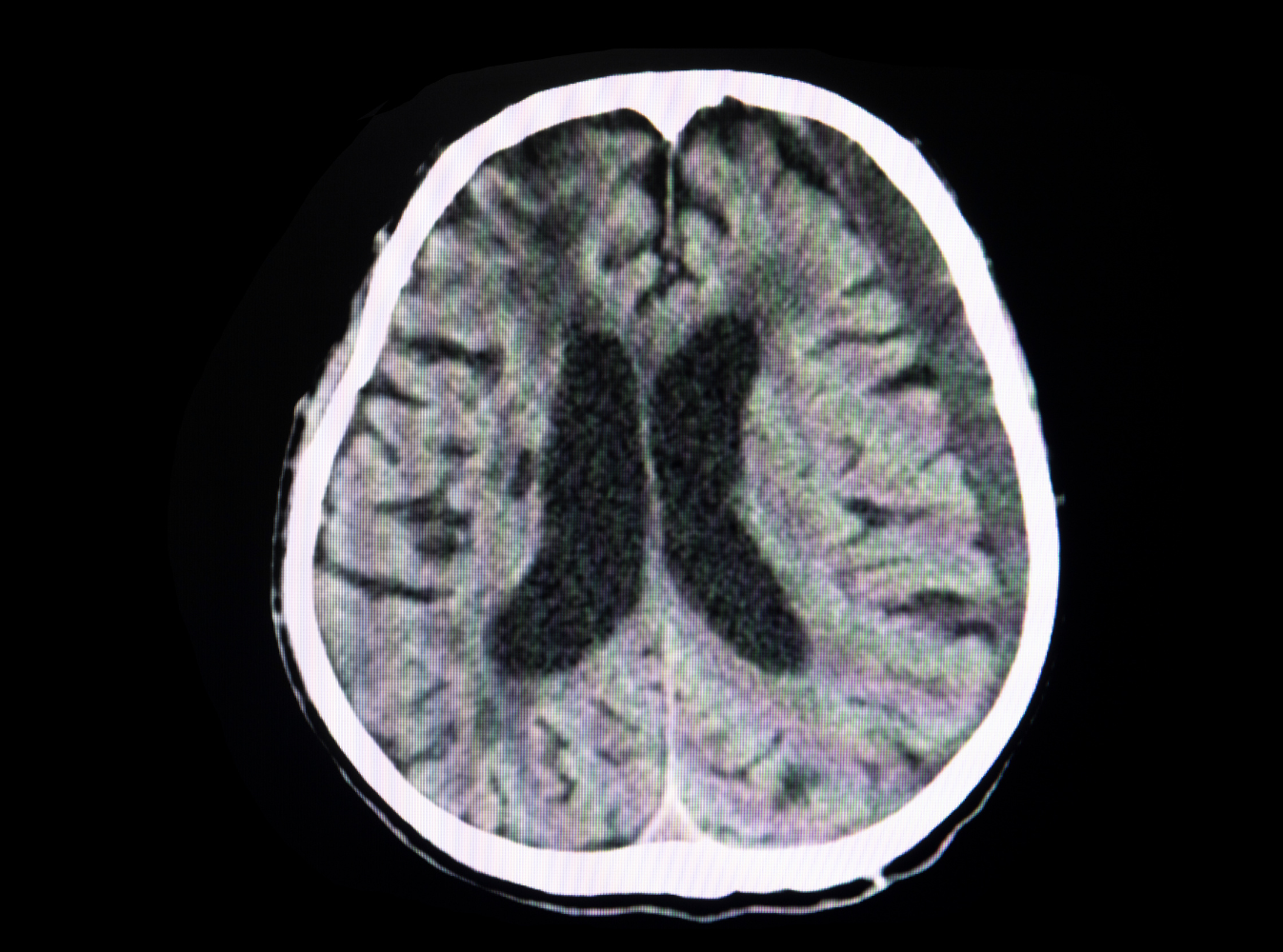 subdural hematoma brain scan