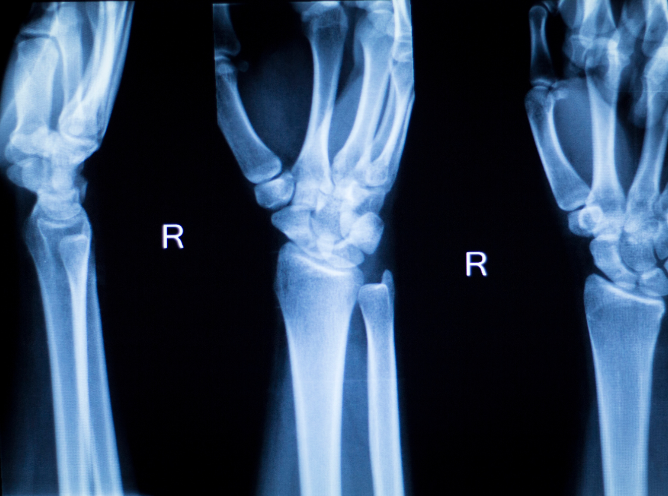 hand and wrist injury xray