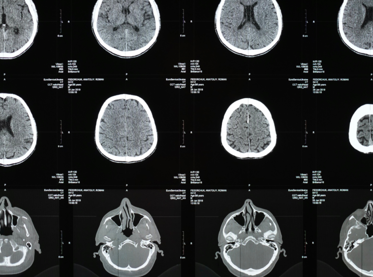 black and white brain scans