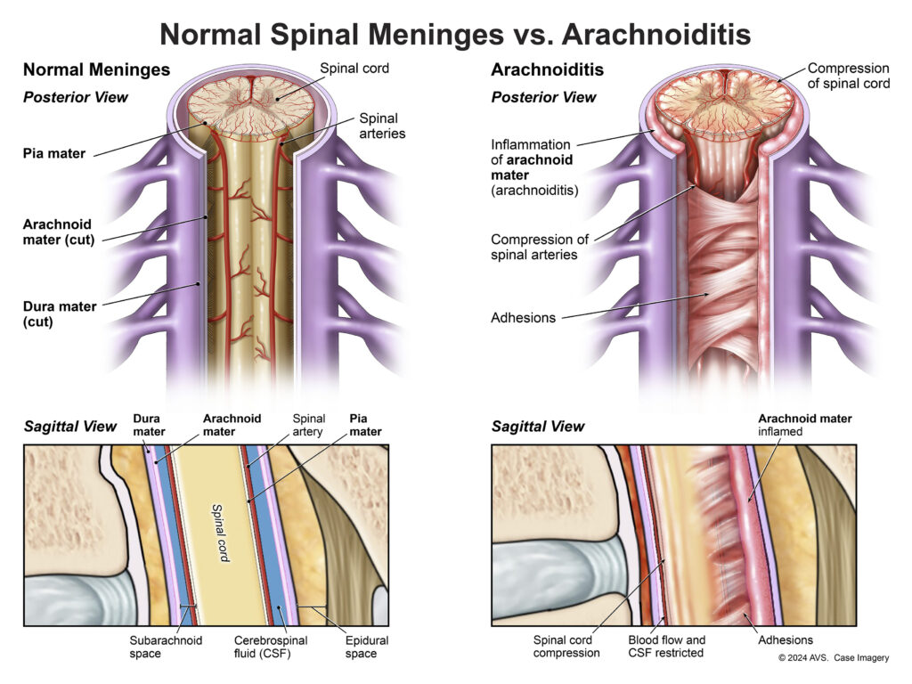 diagram of a healthy spine compared to a spine with arachnoiditis